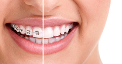 Braces vs Invisalign